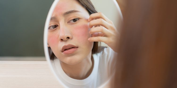 Afecțiuni ale pielii care se manifestă prin iritații și eczeme