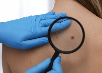 Ce este cancerul de piele și ce trebuie să știi despre această afecțiune?